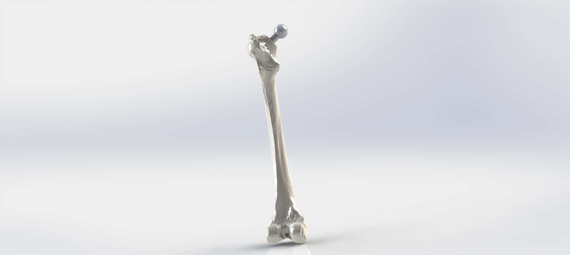 Optimizing Hip Prostheses Material & Geometry